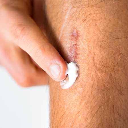Application of scar cream