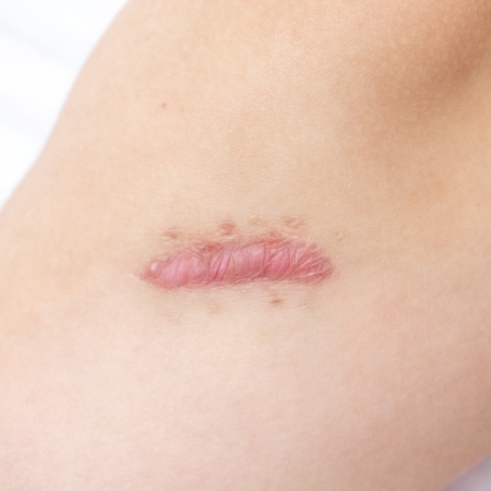 How to care for your scar after stitching? Here's the best tips!