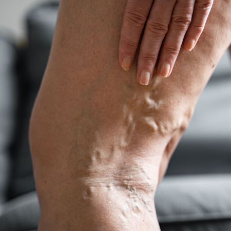 Varicose Veins