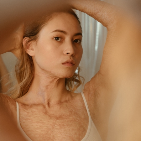 Women with burns scar