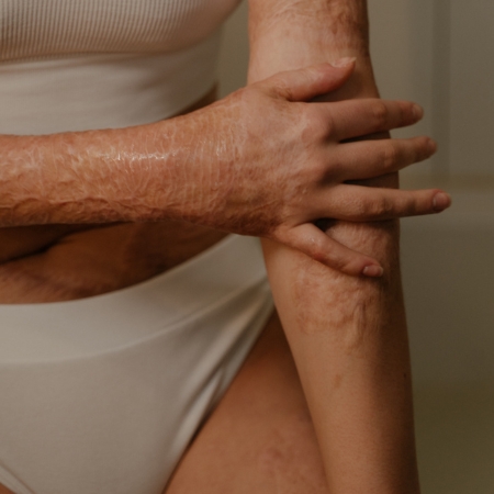 Burn scar