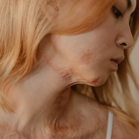 A Woman with Burn Scars