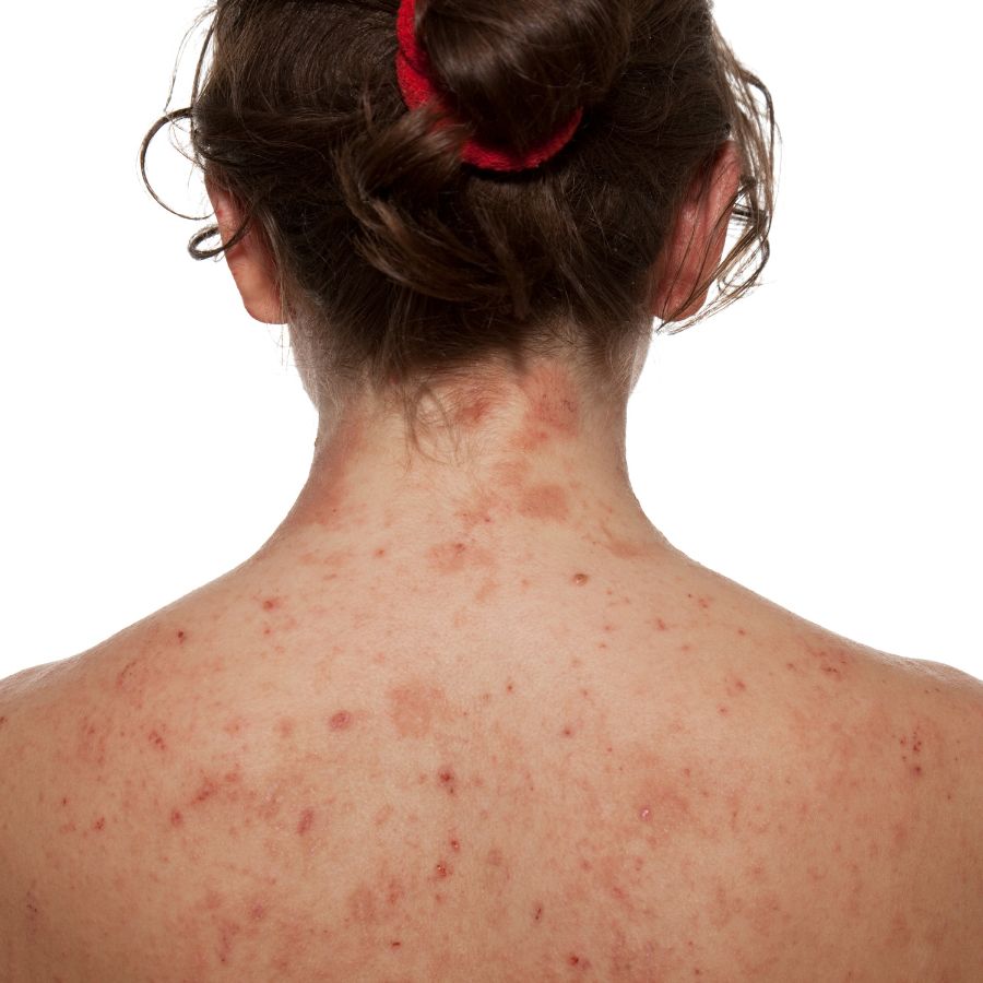 Female with eczema on her back