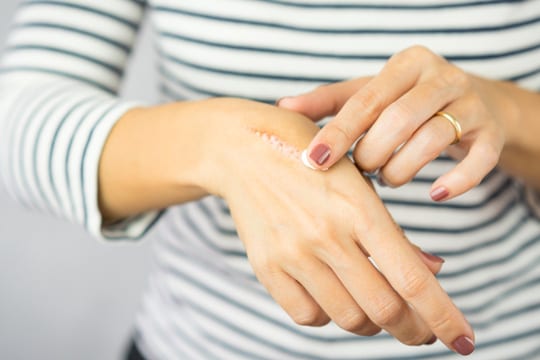 applying alhydran cream on a scar on hand